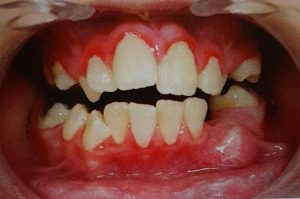 Patient with mouth breathing exhibiting marginal gingivitis