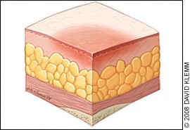 Stage-1 pressure ulcer