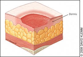 stage 2 pressure ulcer