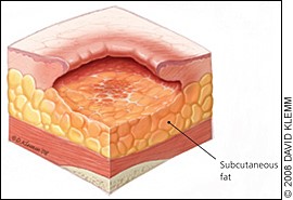 stage 3 pressure ulcer