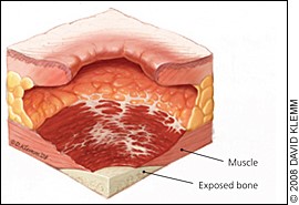 stage 4 pressure ulcer